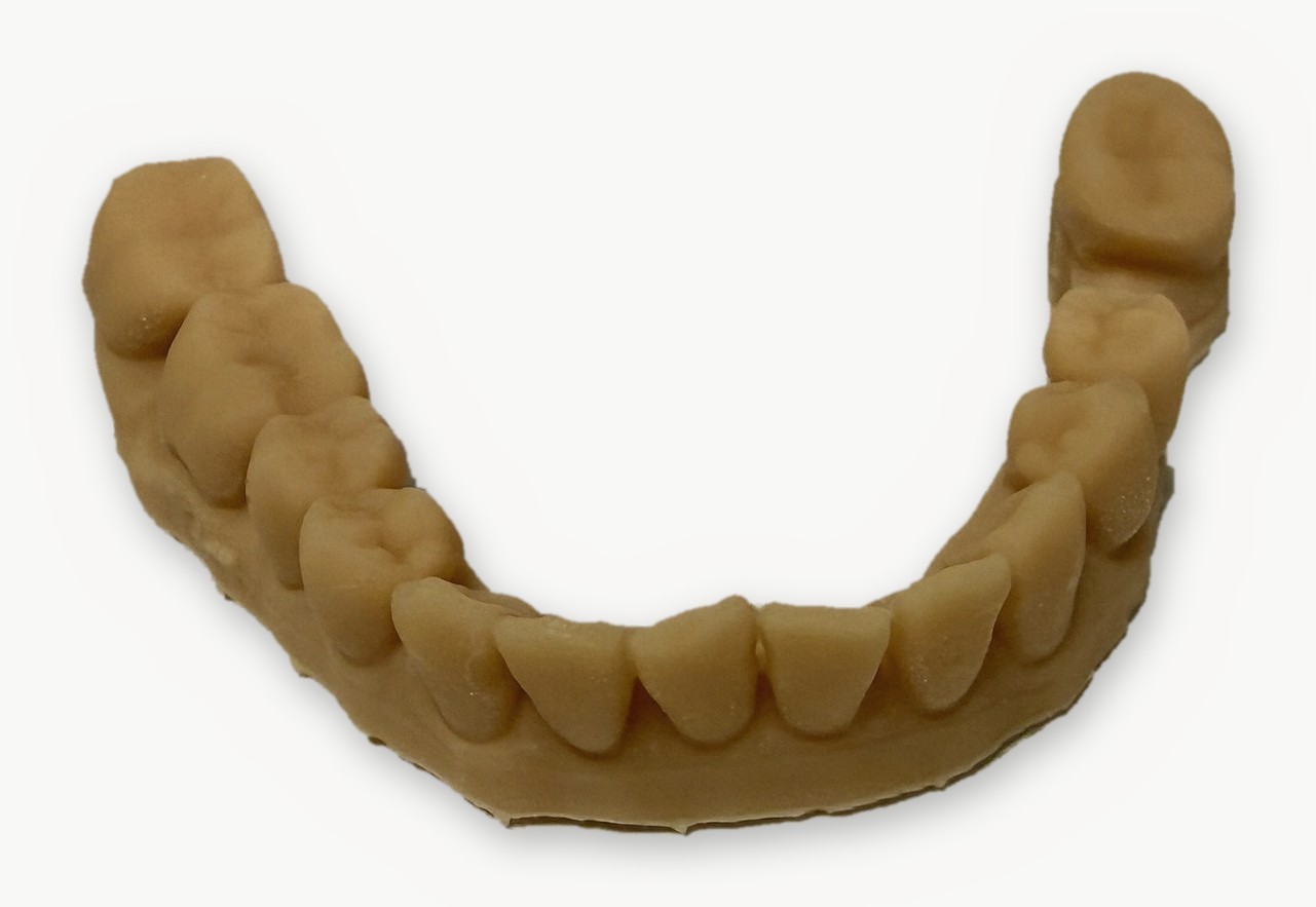 3D printed dental model made in-house at Midtown Dental Calgary